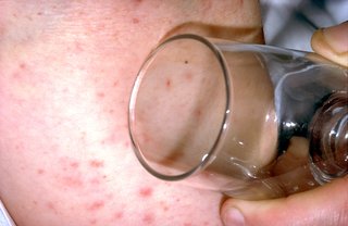 Press the side of a clear glass firmly against the skin. If the rash does not fade, it's a sign of blood poisoning (septicaemia) caused by meningitis. Get medical help immediately.