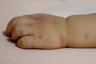 Red spots on the hand of baby