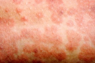 Close-up of skin with a measles rash. The red, raised spots are joined together in blotchy patches