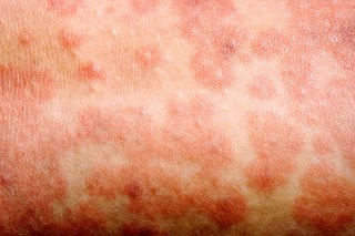 Close-up of skin with a measles rash. The red, raised spots are joined together in blotchy patches. Shown on white skin.