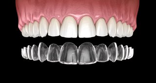 diagram of removable aligners