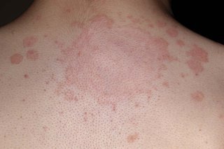 ringworm spreading on the back