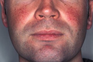 Close up of red patches caused by rosacea on the cheeks of a man with white skin.