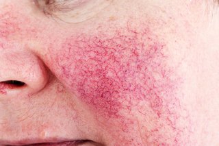 Broken blood vessels caused by rosacea on the cheek of a woman with white skin.