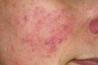 Redness on the cheek of a person with white skin.