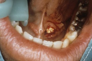 White hard salivary gland stones under the tongue