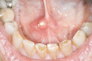 Two small white salivary gland stones under the tongue