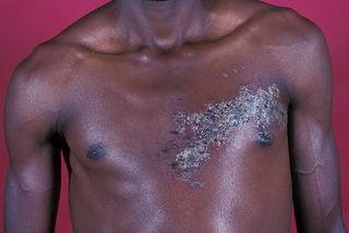 A large scabbed area on one side of someone's chest. Shown on black skin.