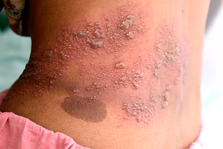 A large area of blisters on someone's back. Shown on brown skin.