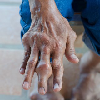 Fingers of person with gout