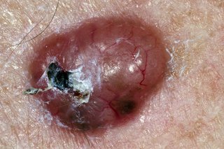 Red lump with dark brown patches on white skin