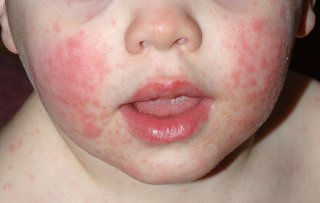 Child's face with bright red rash on white skin - redness and raised bumps on each cheek.