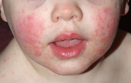 Slapped cheek syndrome - HSE.ie