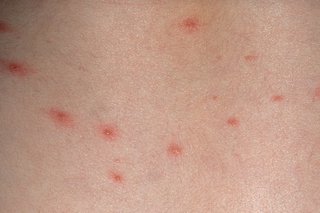 Red spots on white skin that are set apart from each other and small in size.