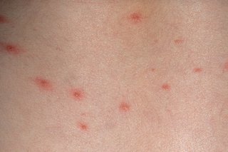 Chickenpox in outlet children