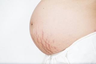 stretch marks on the tummy during pregnancy
