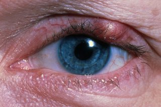 a stye on the upper eyelid