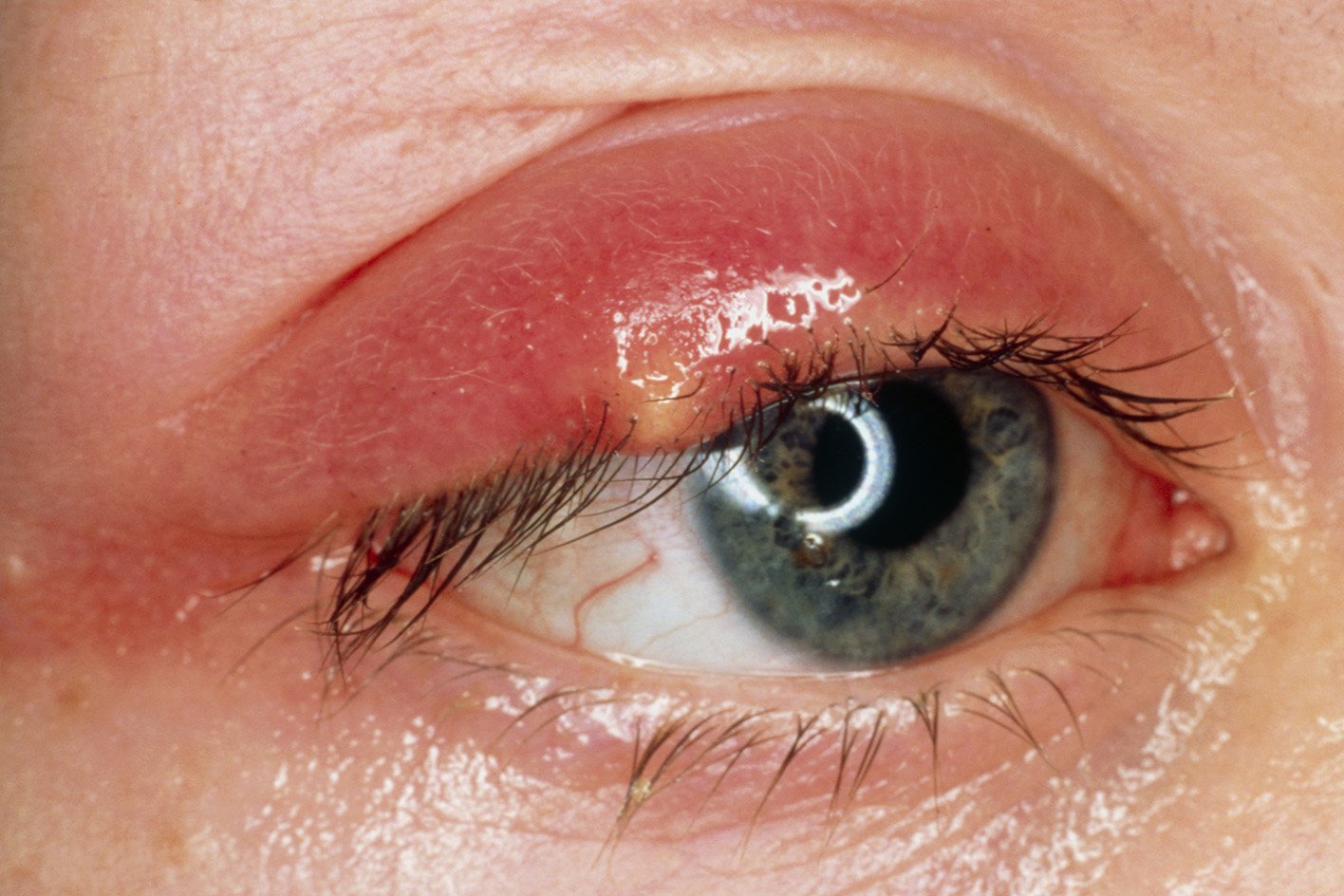 Stye HSE ie