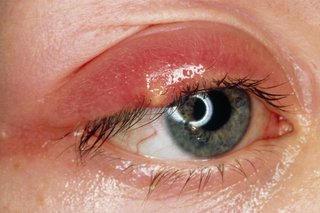 red and swollen upper eyelid with a stye