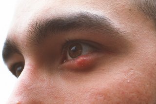 a stye on the lower eyelid