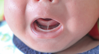 Baby with tongue tie, there is some skin attaching the tongue to the base of the mouth