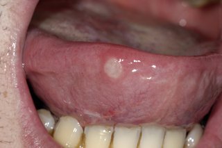 fever blister on tongue