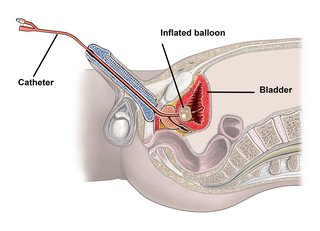 urinary catheter types