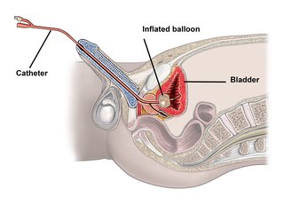 Diagram showing an indwelling catheter (Foley catheter)