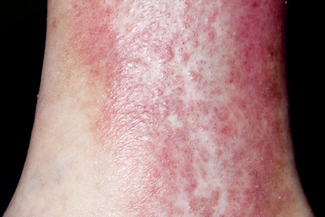 Eczema - Symptoms And Diagnosis - HSE.ie