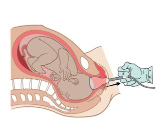 Diagram of a ventouse bith