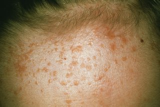 A cluster of yellow plane warts spread across a forehead, shown on white skin.
