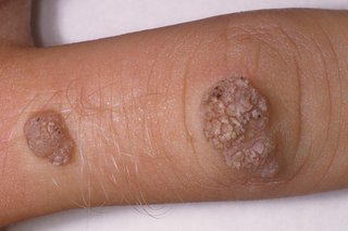 Two raised oval-shaped warts with a rough texture shown on a finger with white skin.