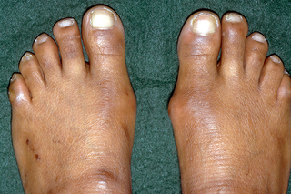 Brown feet with hard lumps on the side of the feet at the base of the big toes